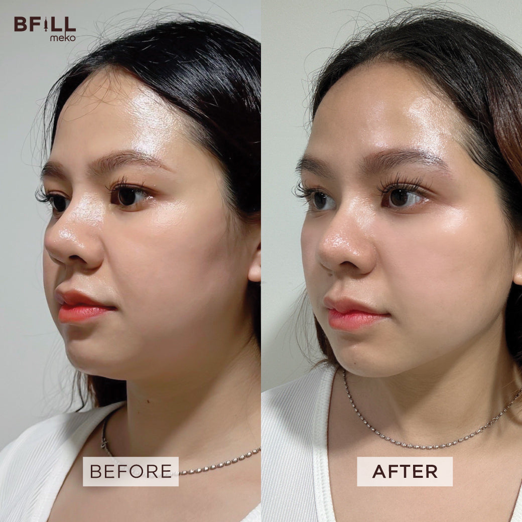 Program Ultraformer III by Doctor Free Therma Lift by Specialist ไม่รวมยาชา (ยาชาเพิ่ม 200บาท)