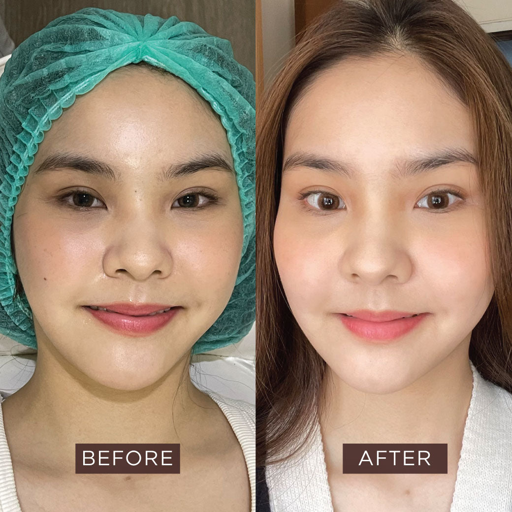 Rejuran (Repair & Healing & Anti-Ageing)