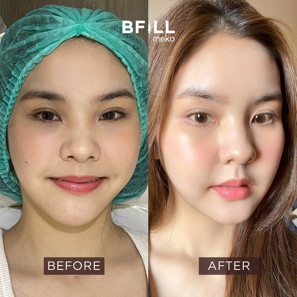 Rejuran (Repair & Healing & Anti-Ageing)