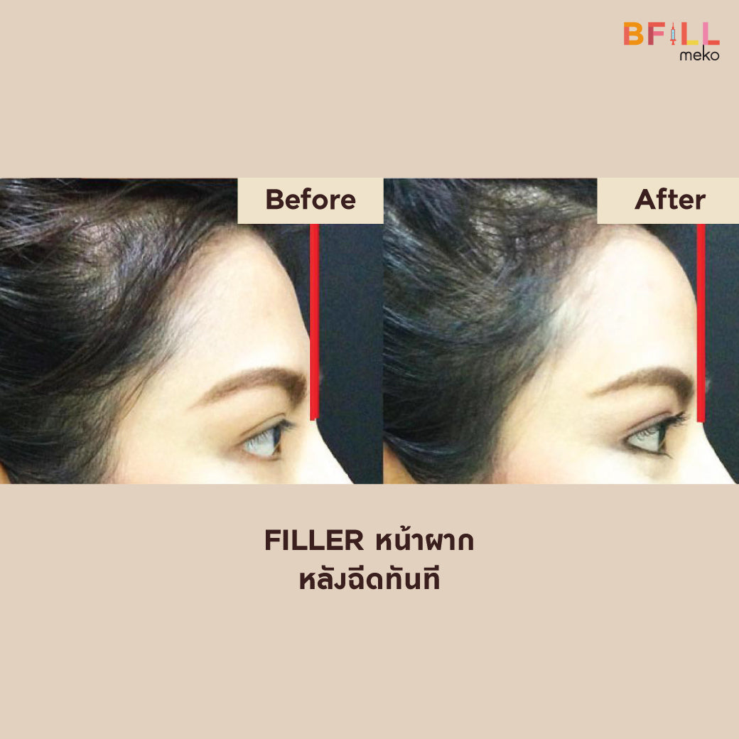 FILLER Korea or Restylane or Juvederm