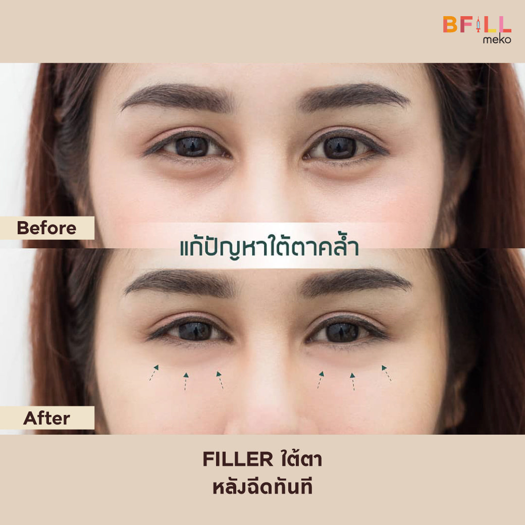 FILLER Korea or Restylane or Juvederm