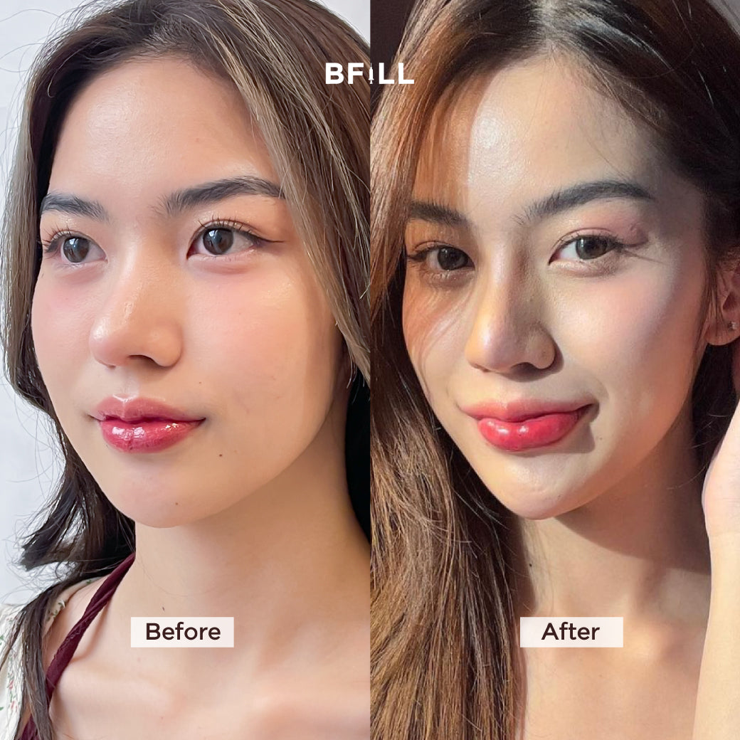 Botox Allergan 100U ボトックス アメリカ 注射部位を選択可能 Only Asok
