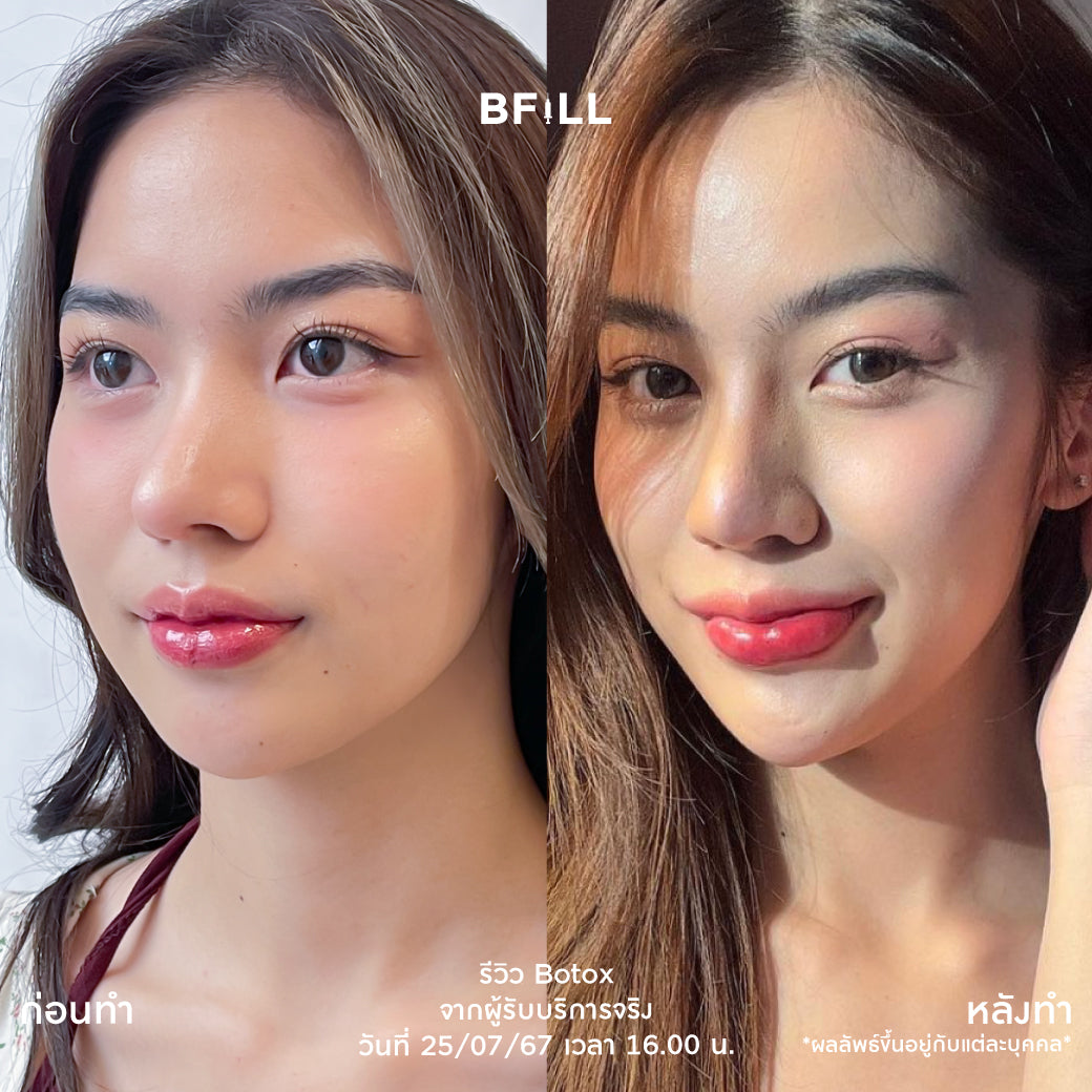 Botox Allergan 100U 肉毒杆菌 美国 可选择注射部位 Only Asok