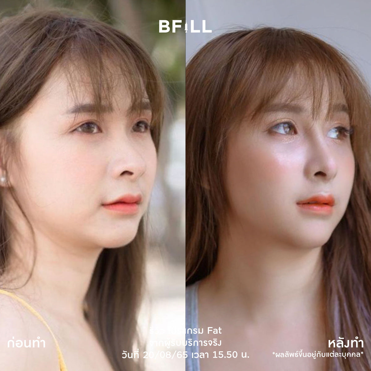 Program Fat Face Treatment: Cheeks and Double Chin Fat Reduction