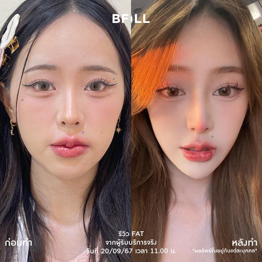 Fat Bomb 脂肪炸弹 脸颊 双下巴 脂肪分解