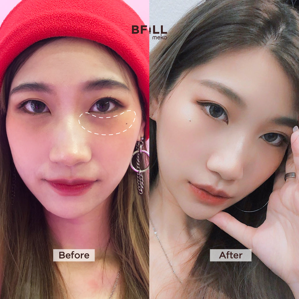 FILLER Korea or Restylane or Juvederm
