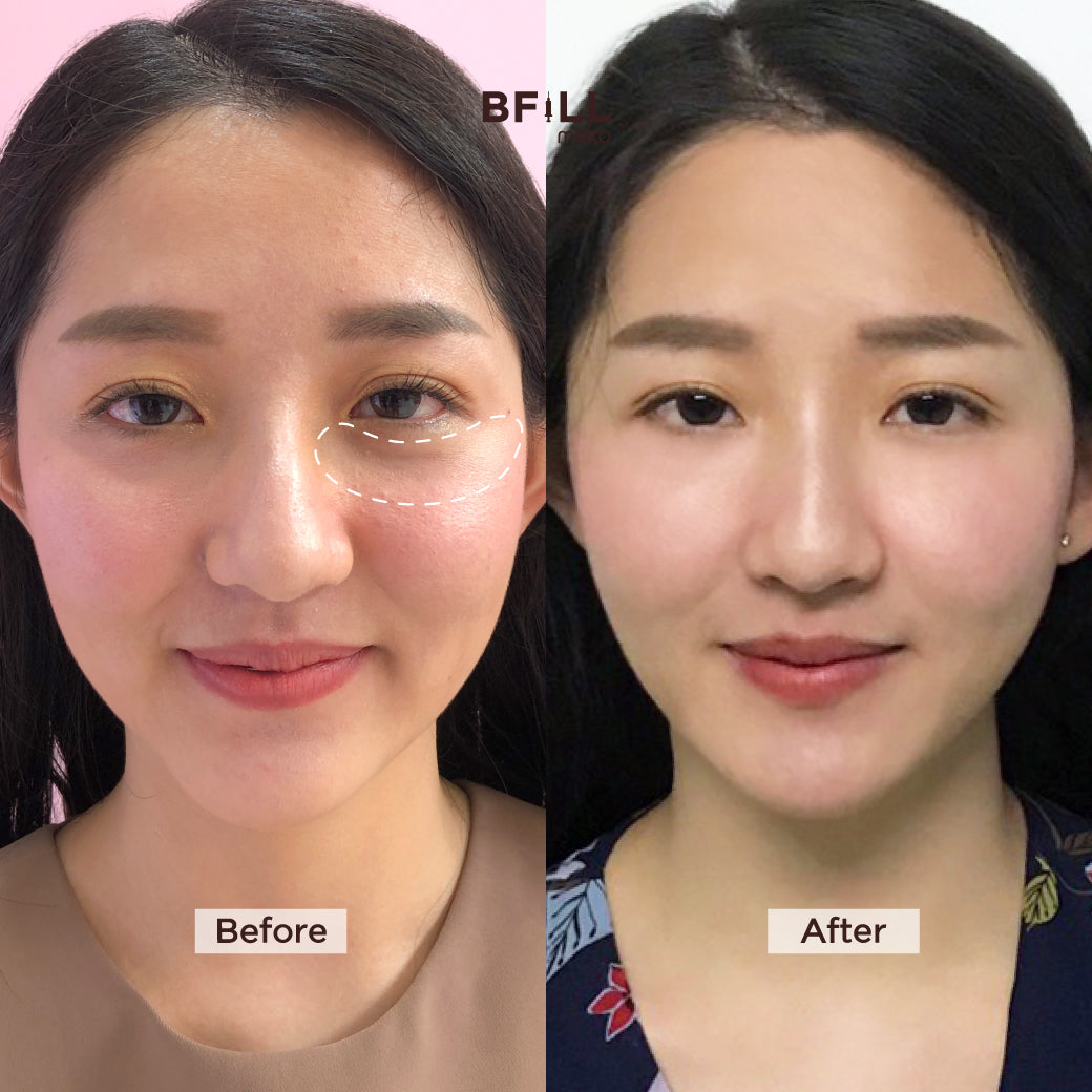 FILLER Korea or Restylane or Juvederm