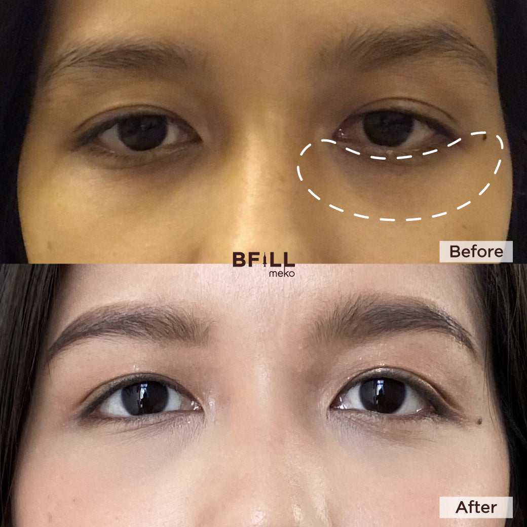FILLER Korea or Restylane or Juvederm