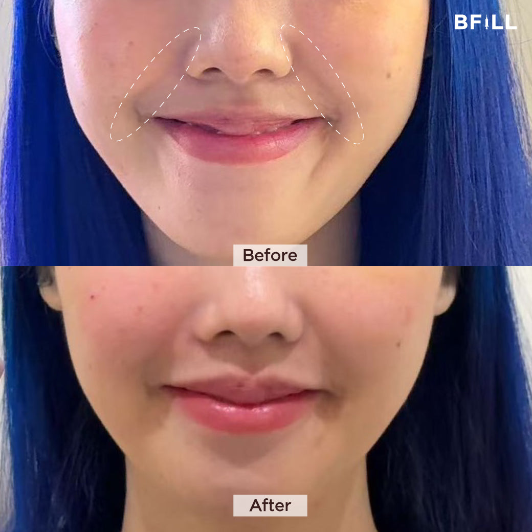 FILLER Korea or Restylane or Juvederm