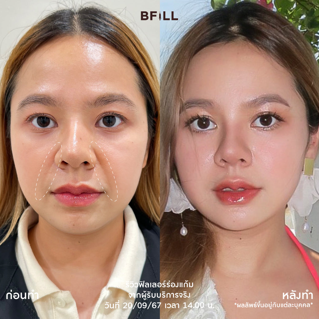 Program FILLER Neuramis or E.P.T.Q. or Volifil or Restylane or Juvederm