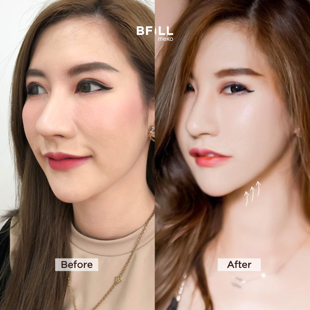 Premium Hifu By Specialist พรีเมียม ไฮฟู่ (ทำโดยผู้เชี่ยวชาญ)