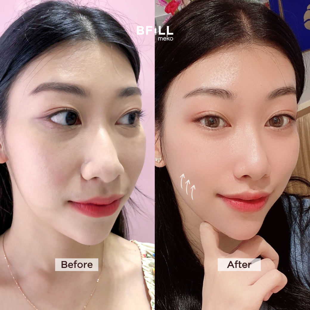 Premium Hifu By Specialist (Performed by Experts) Premium Hifu Skin Lifting Stimulates New Collagen Production