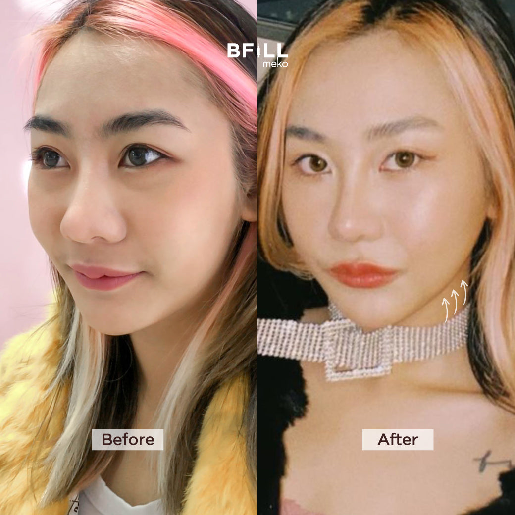 Premium Hifu By Specialist พรีเมียม ไฮฟู่ (ทำโดยผู้เชี่ยวชาญ)