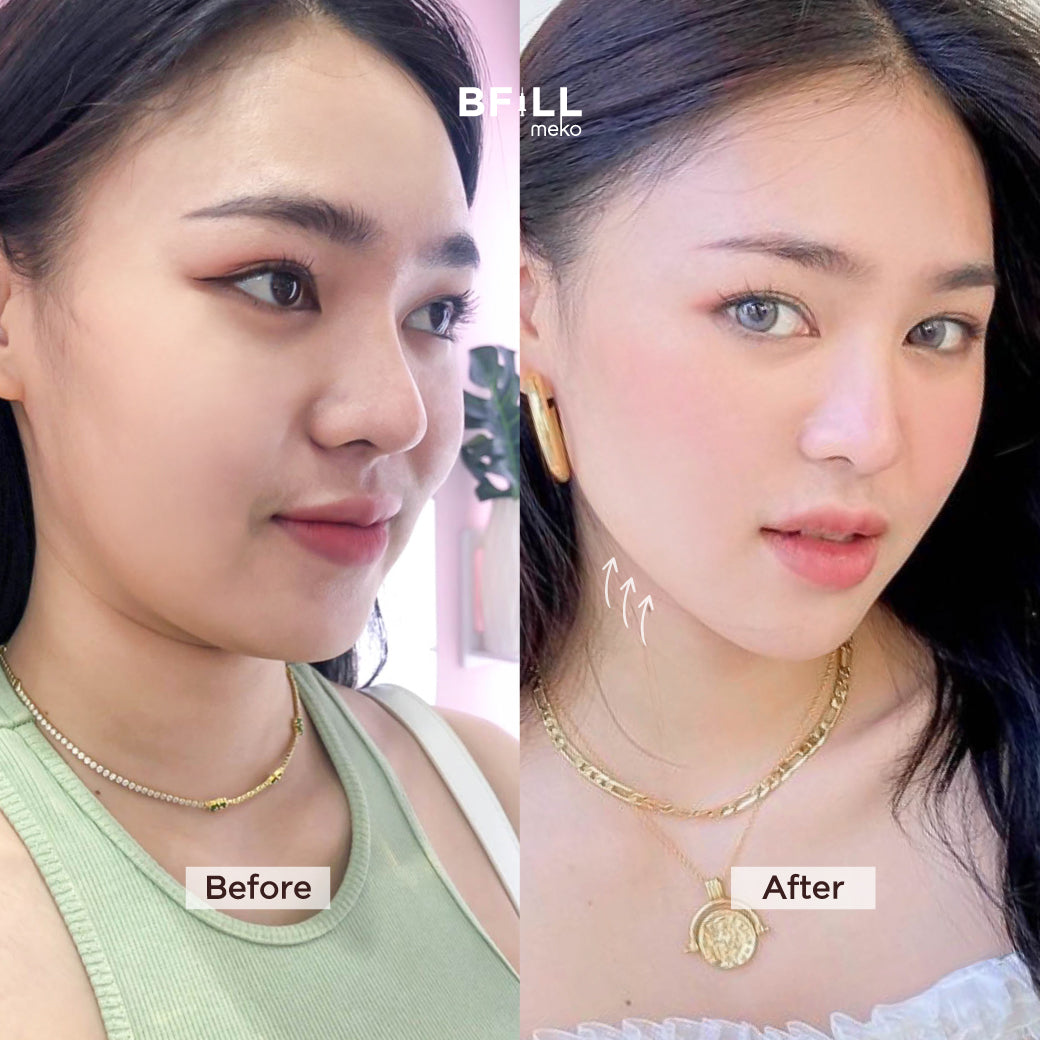 Premium Hifu By Specialist (Performed by Experts) Premium Hifu Skin Lifting Stimulates New Collagen Production