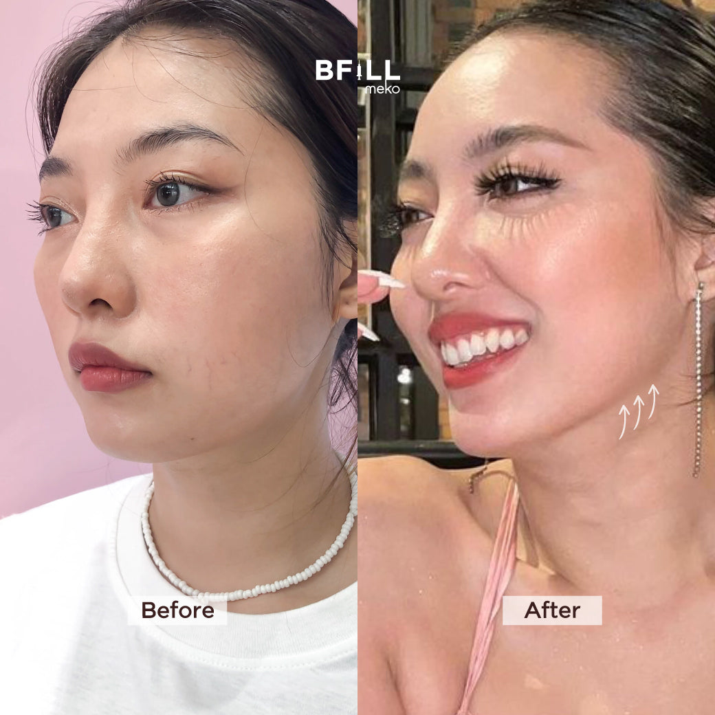 Premium Hifu By Specialist พรีเมียม ไฮฟู่ (ทำโดยผู้เชี่ยวชาญ)