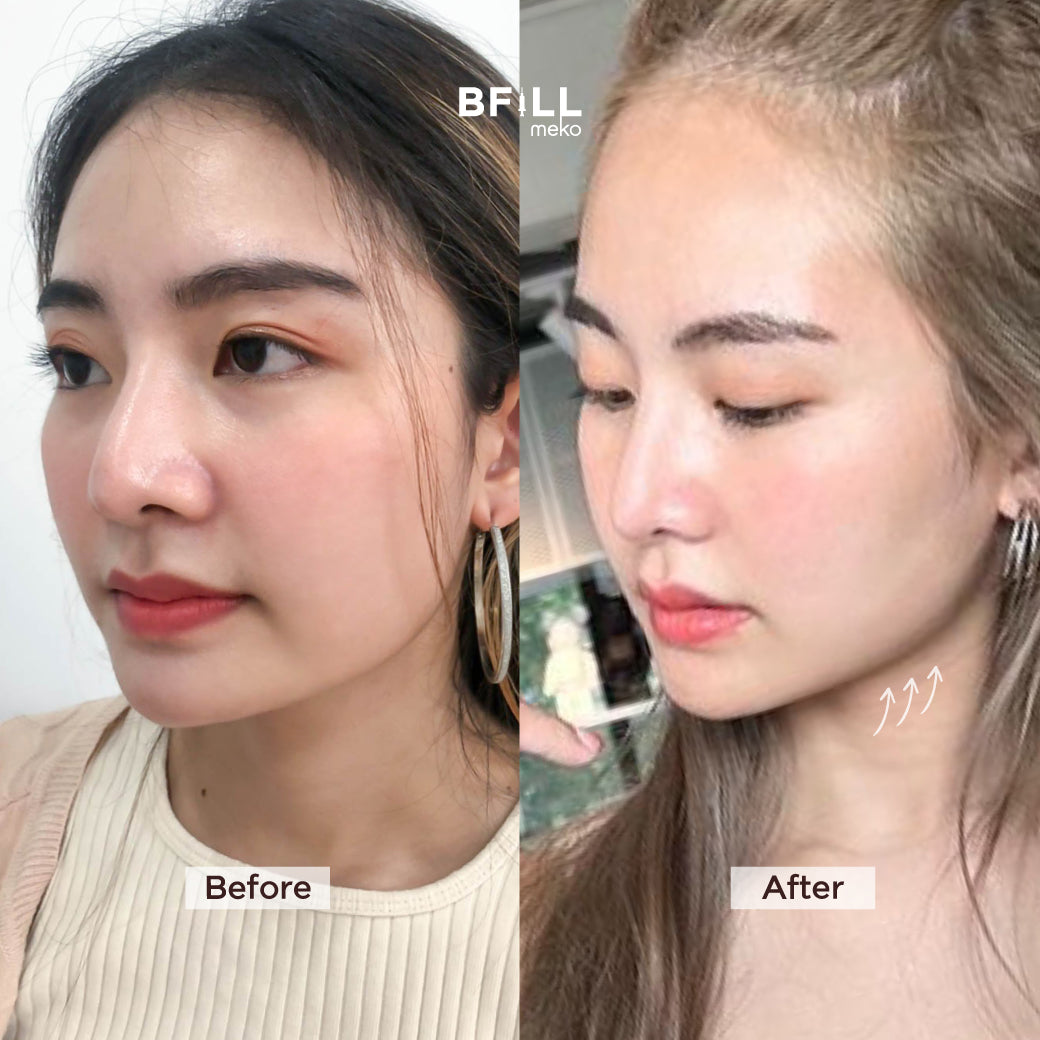 Premium Hifu By Specialist พรีเมียม ไฮฟู่ (ทำโดยผู้เชี่ยวชาญ)