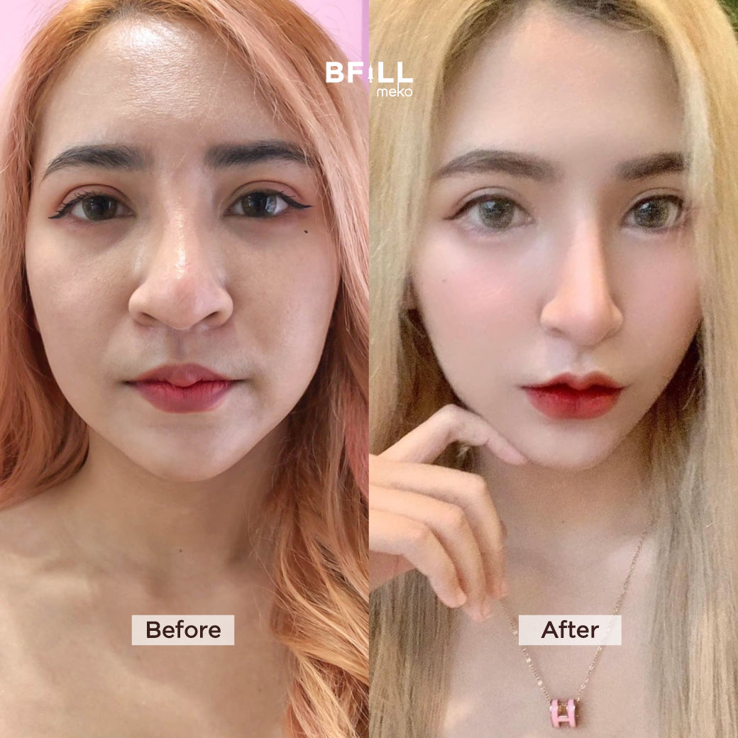 Premium Hifu By Specialist พรีเมียม ไฮฟู่ (ทำโดยผู้เชี่ยวชาญ)