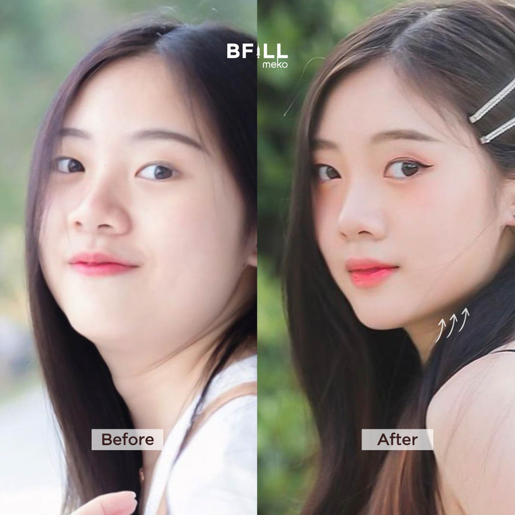 专家级高端Hifu(由专家操作)