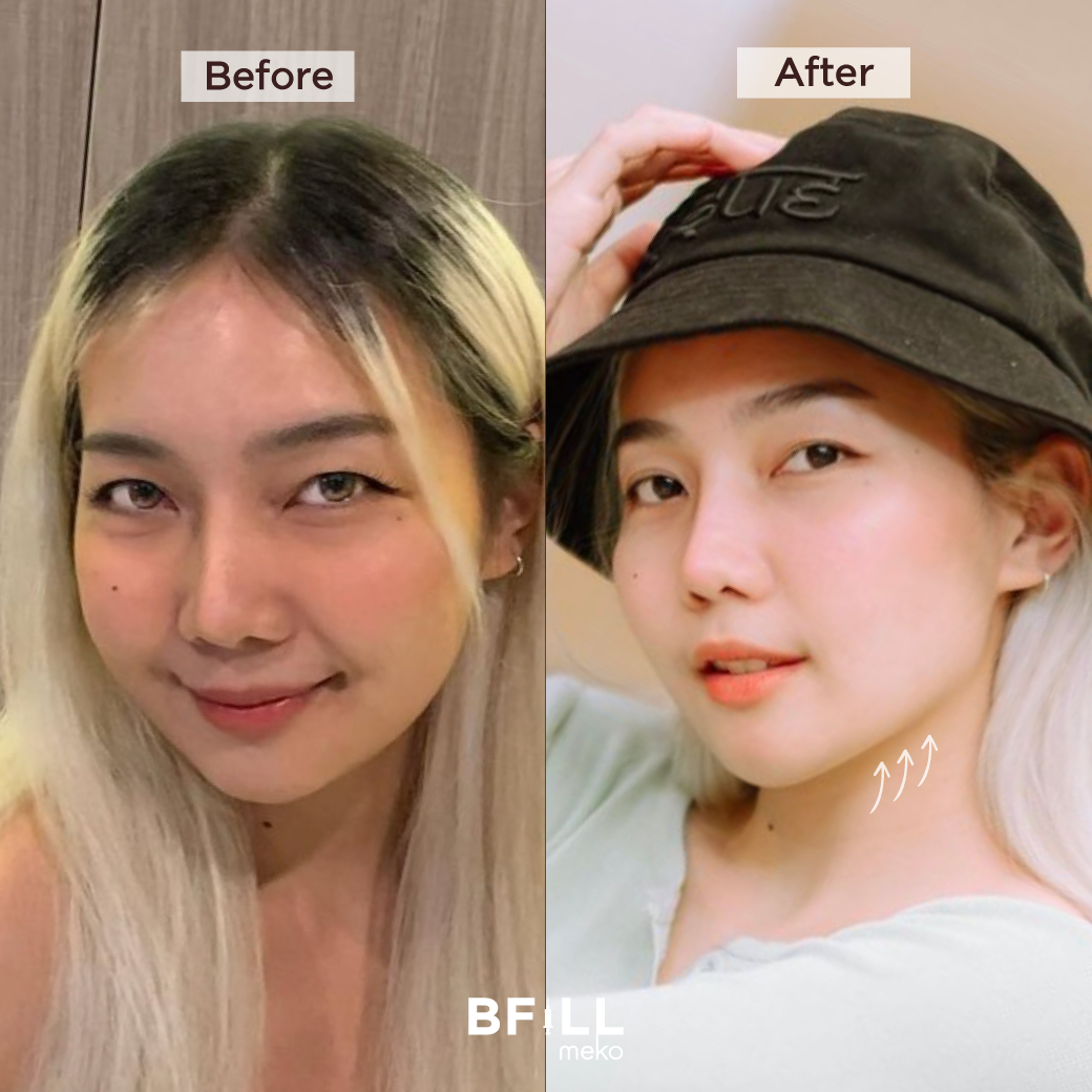 Hifu Hi Lift ไฮลิฟท์ by Specialist (ทำโดยผู้เชี่ยวชาญ) "ไม่รวมหน้าผาก Excluding forehead"