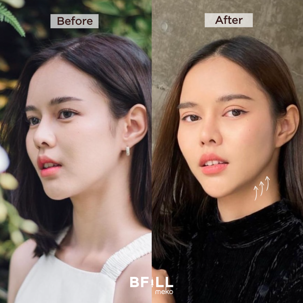 Hifu Hi Lift ไฮลิฟท์ by Specialist (ทำโดยผู้เชี่ยวชาญ) "ไม่รวมหน้าผาก Excluding forehead"