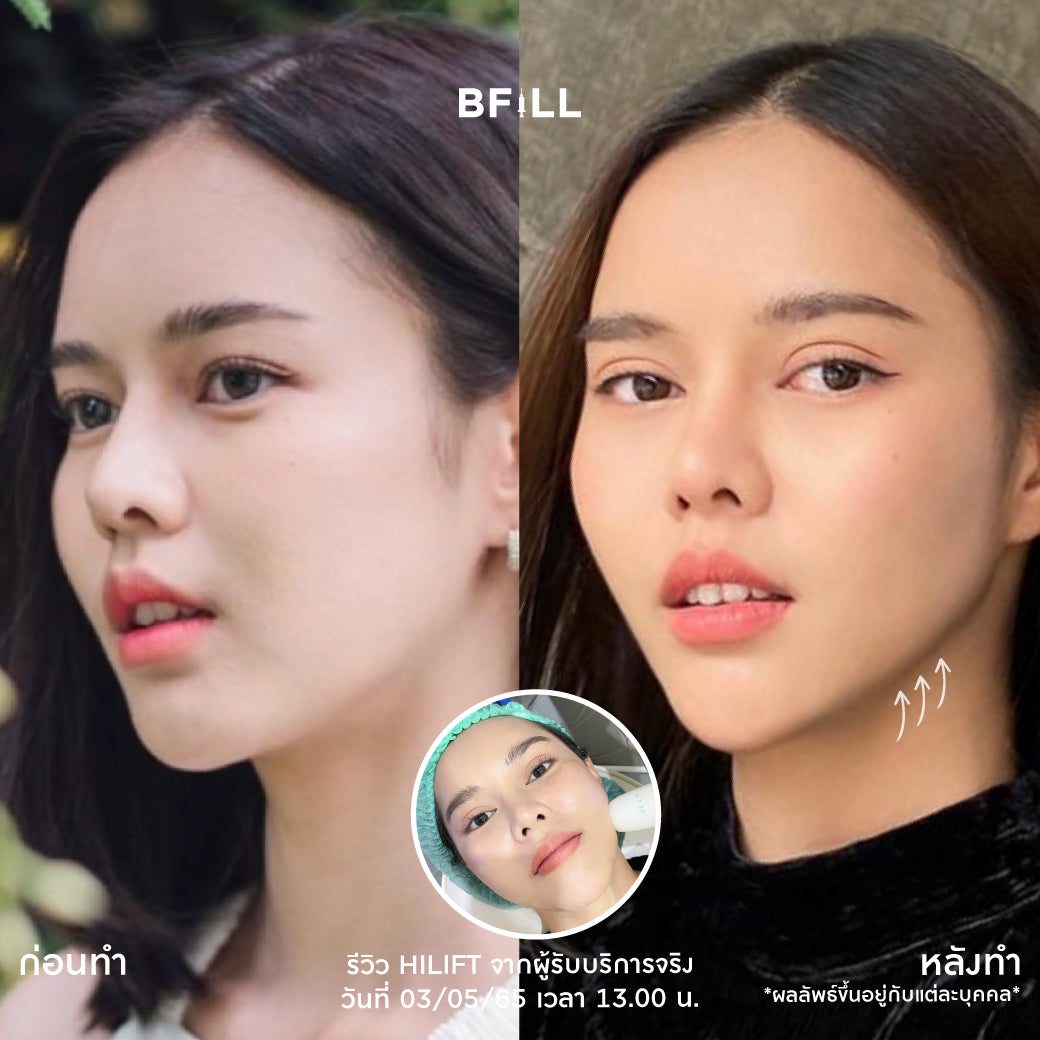 Hifu Hi Lift ไฮลิฟท์ by Specialist (由专家操作) "不包括额头 Excluding forehead" 可分期付款