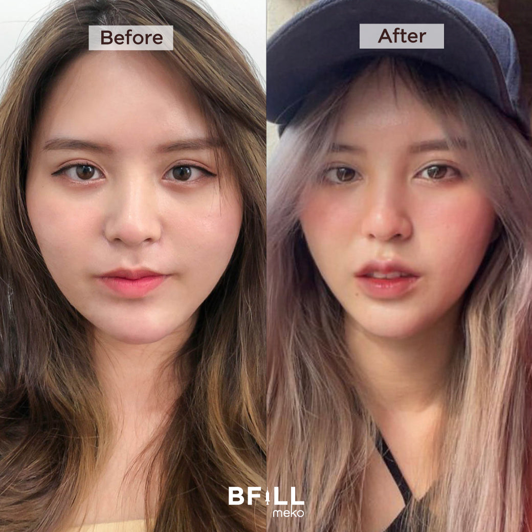 Fat Bomb Fat Bomb Cheeks Double Chin Fat Dissolving