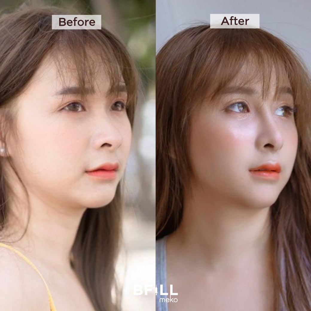 Fat Bomb Fat Bomb Cheeks Double Chin Fat Dissolving