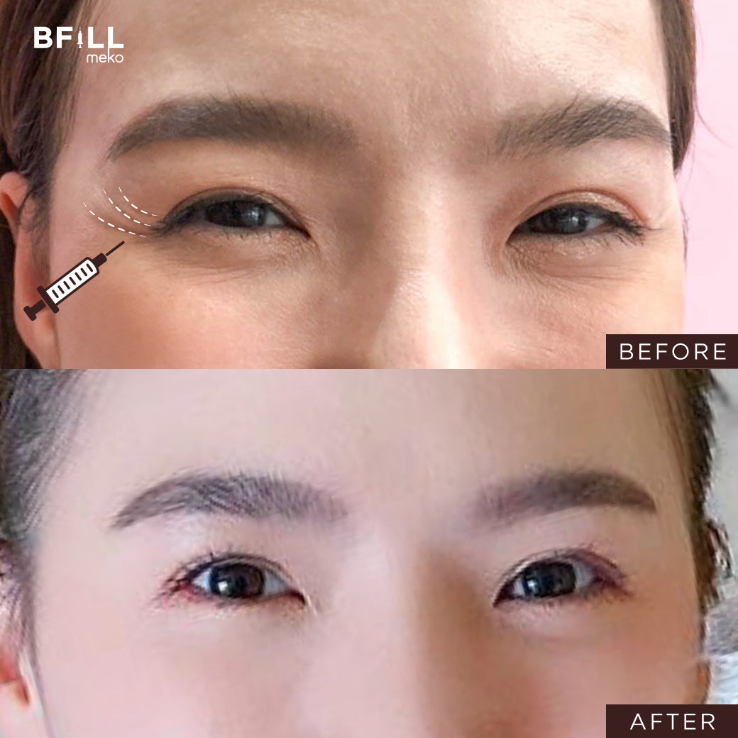 Botox Allergan 100U ボトックス アメリカ 注射部位を選択可能 Only Asok