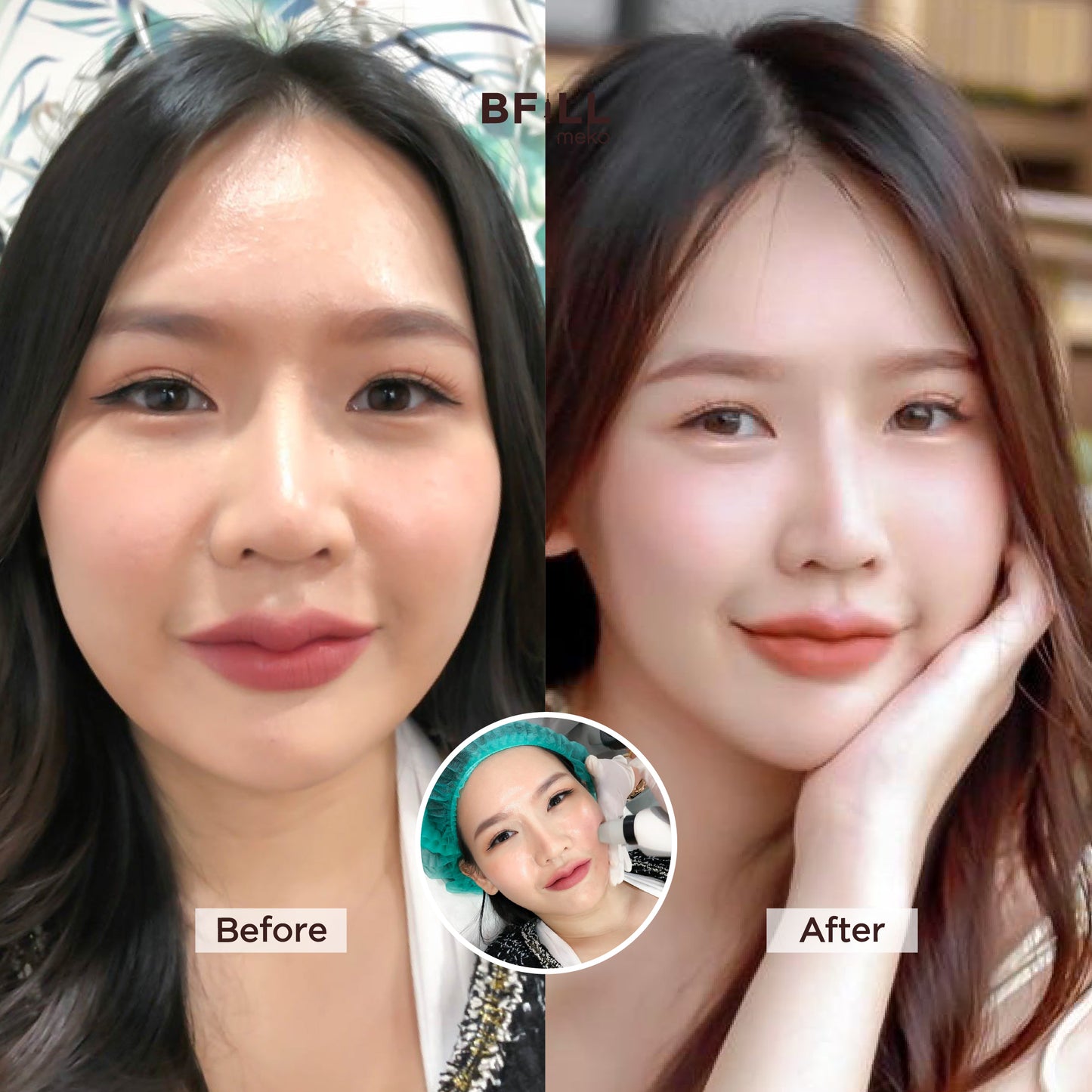 Thermage Korea By Specialist เทอมาจ เกาหลี (ทำโดยผู้เชี่ยวชาญ)