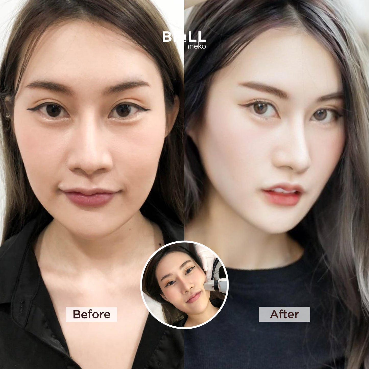 Thermage Korea By Specialist (Performed by Experts) Thermage Korea Reduces Fat, Lifts and Tightens the Face "All Branches"