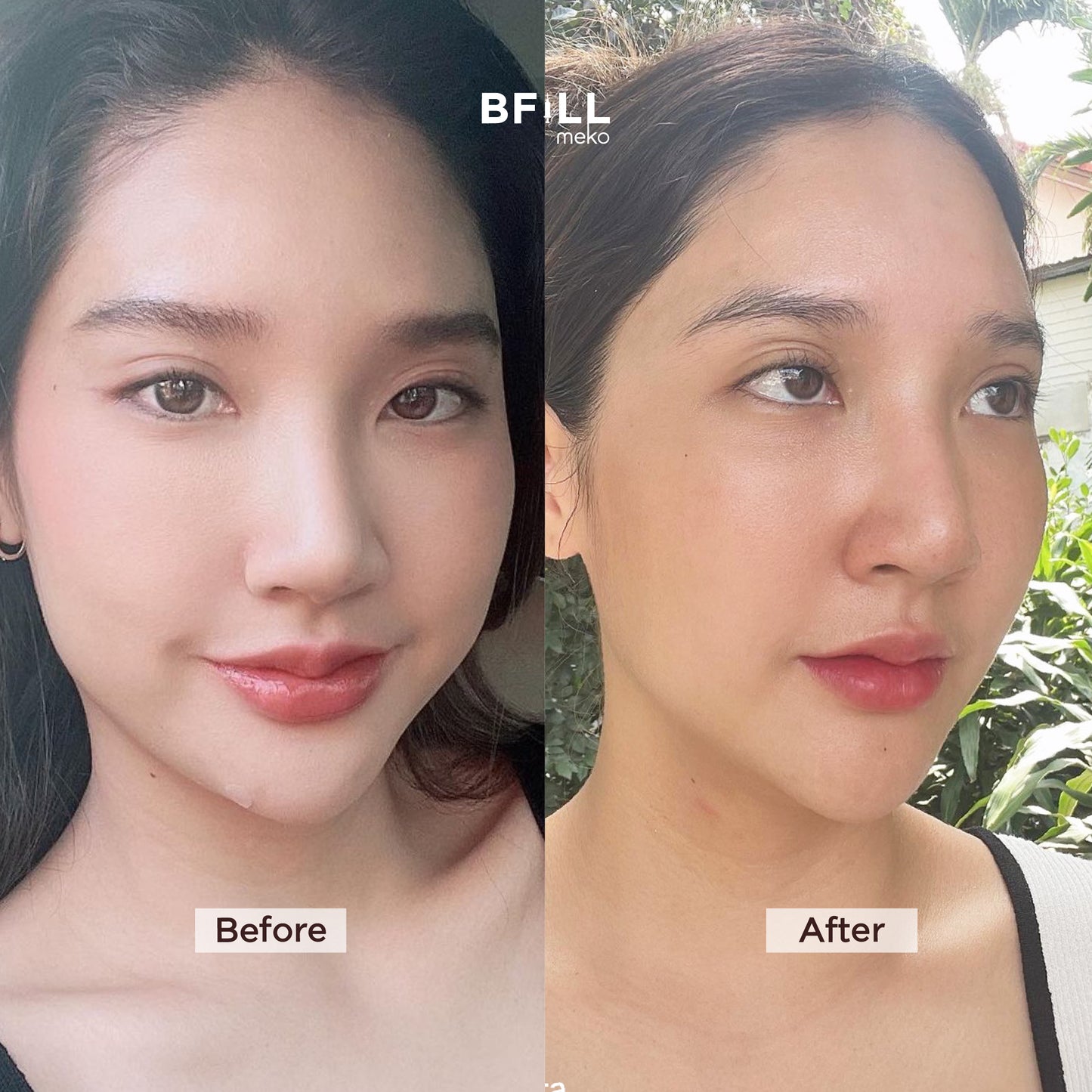Thermage Korea By Specialist เทอมาจ เกาหลี (ทำโดยผู้เชี่ยวชาญ)