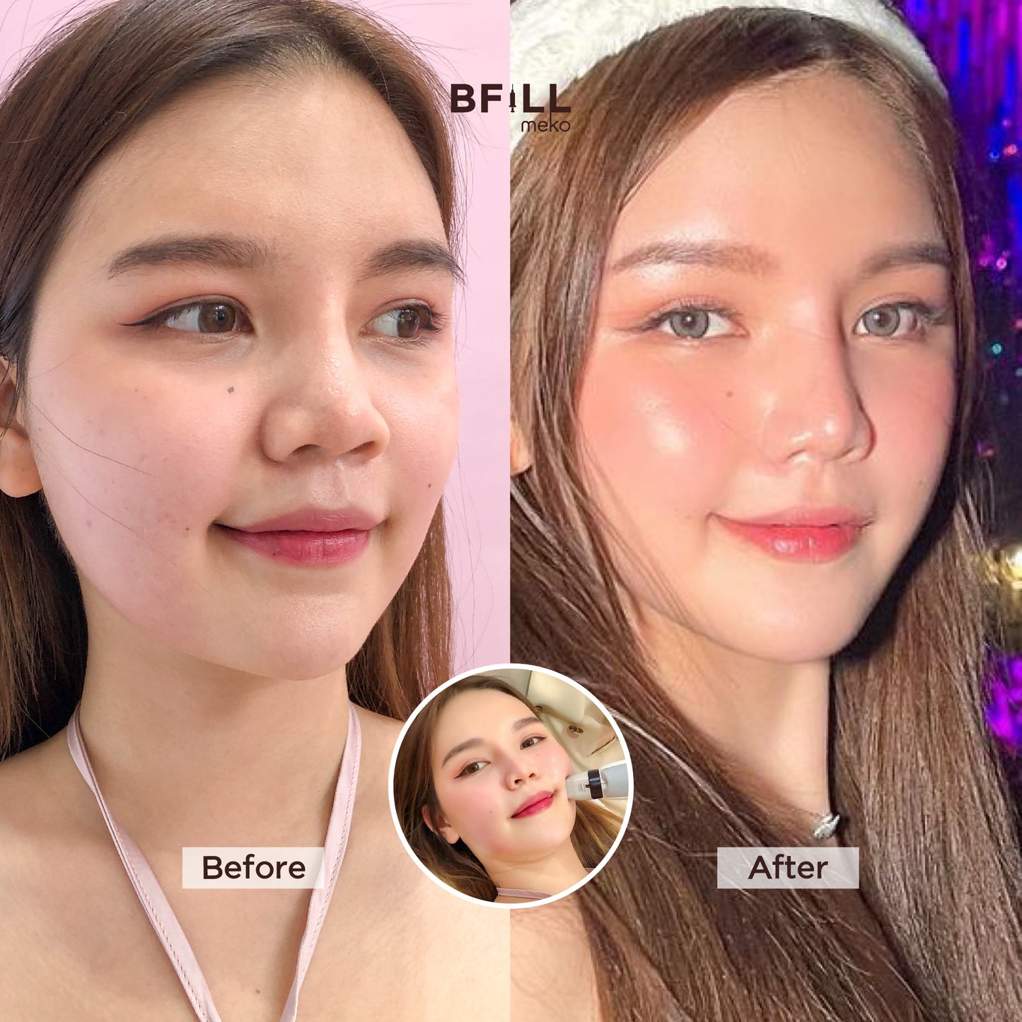 Thermage Korea By Specialist (Performed by Experts) Thermage Korea Reduces Fat, Lifts and Tightens the Face "All Branches"