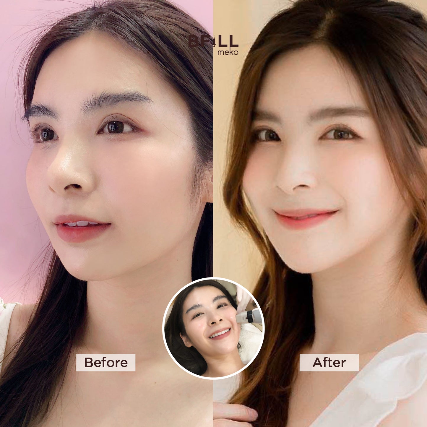 Thermage Korea By Specialist เทอมาจ เกาหลี (ทำโดยผู้เชี่ยวชาญ)
