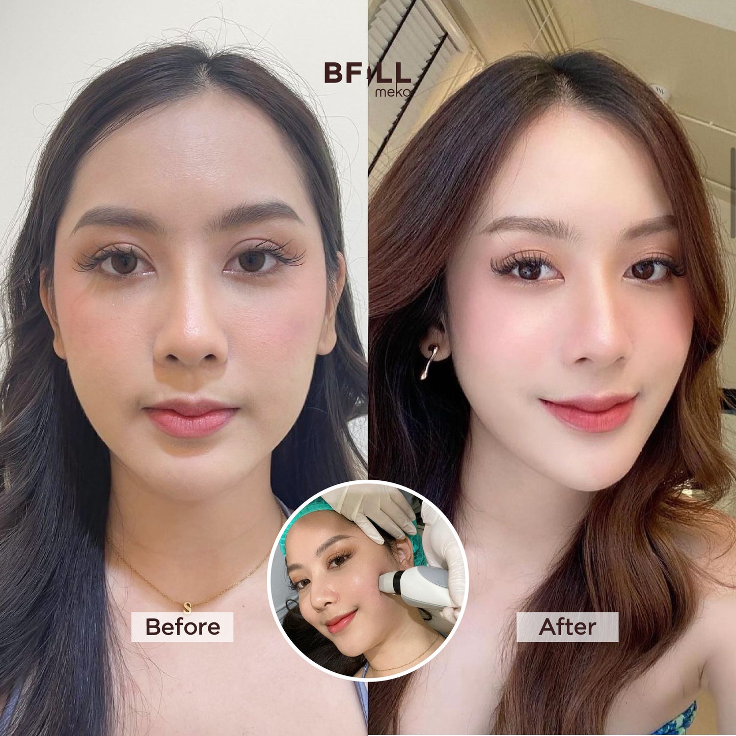 Thermage Korea By Specialist (Performed by Experts) Thermage Korea Reduces Fat, Lifts and Tightens the Face "All Branches"