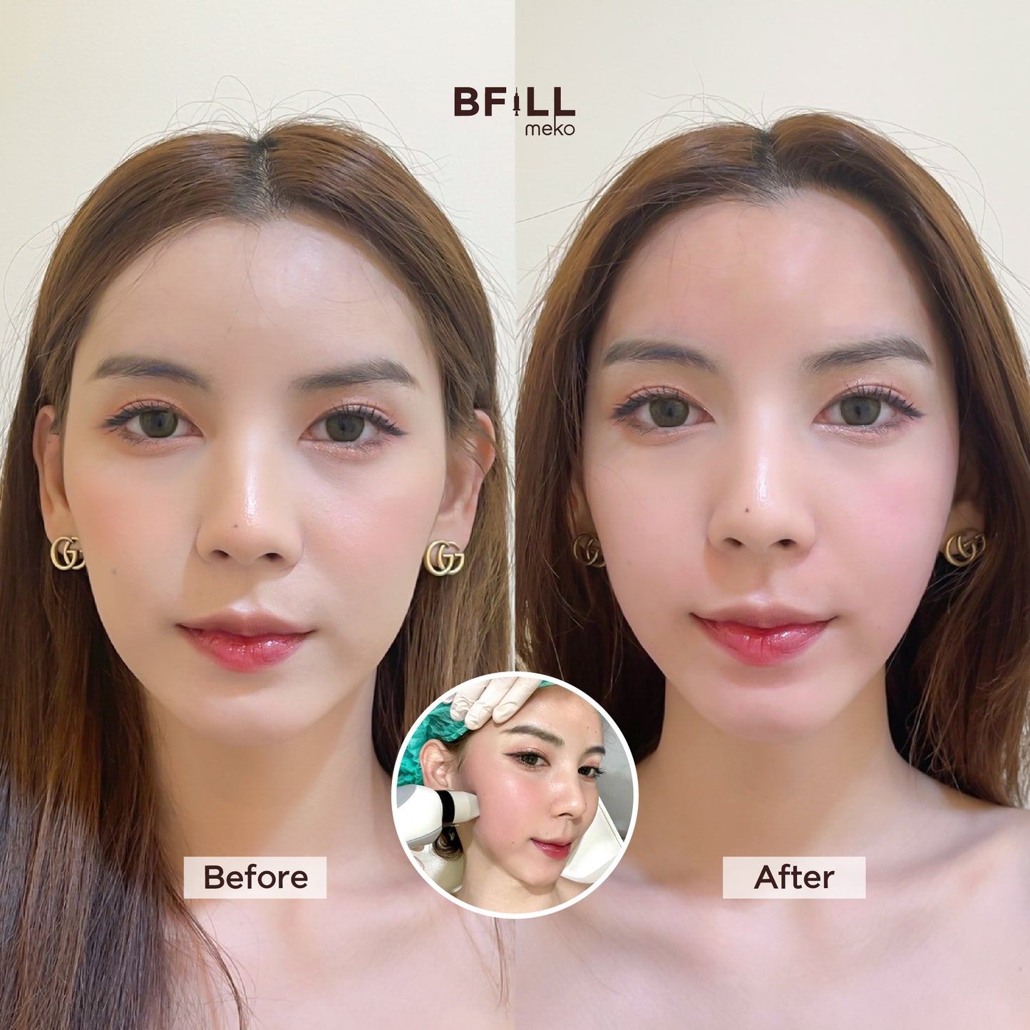 Thermage Korea By Specialist เทอมาจ เกาหลี (ทำโดยผู้เชี่ยวชาญ)