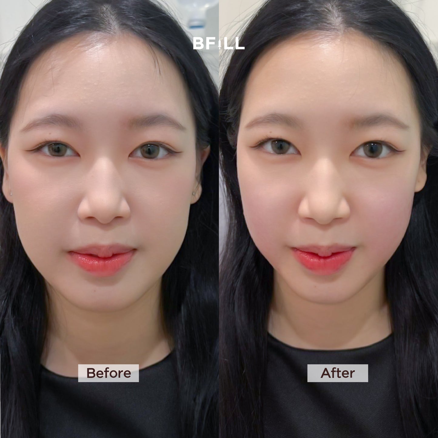 Thermage Korea By Specialist เทอมาจ เกาหลี (ทำโดยผู้เชี่ยวชาญ)