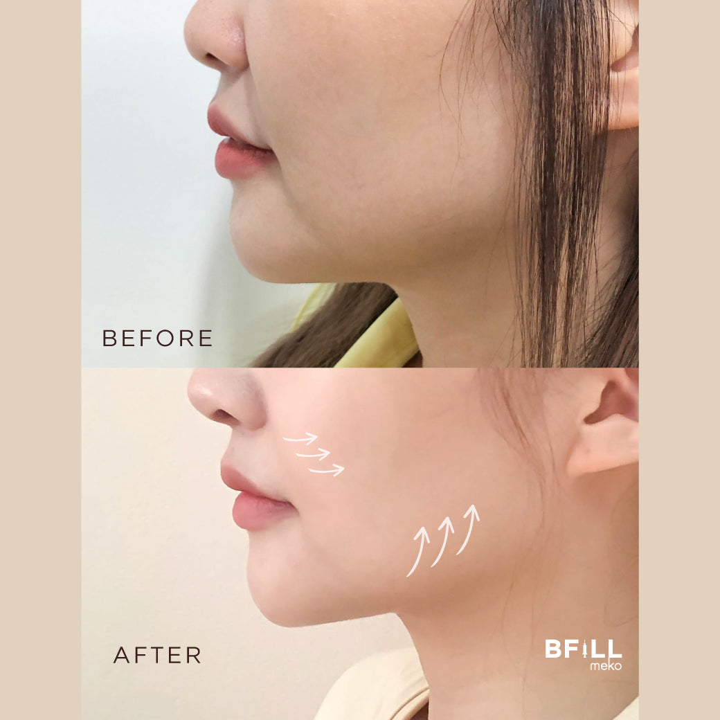 Hifu Hi Lift ハイリフト by Specialist (専門家による施術) リフトアップ コラーゲンを刺激する