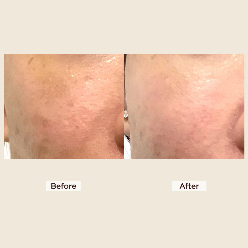 Meso Neo Glutanex Glow Facial Injection with Pure Glutathione, New from Korea