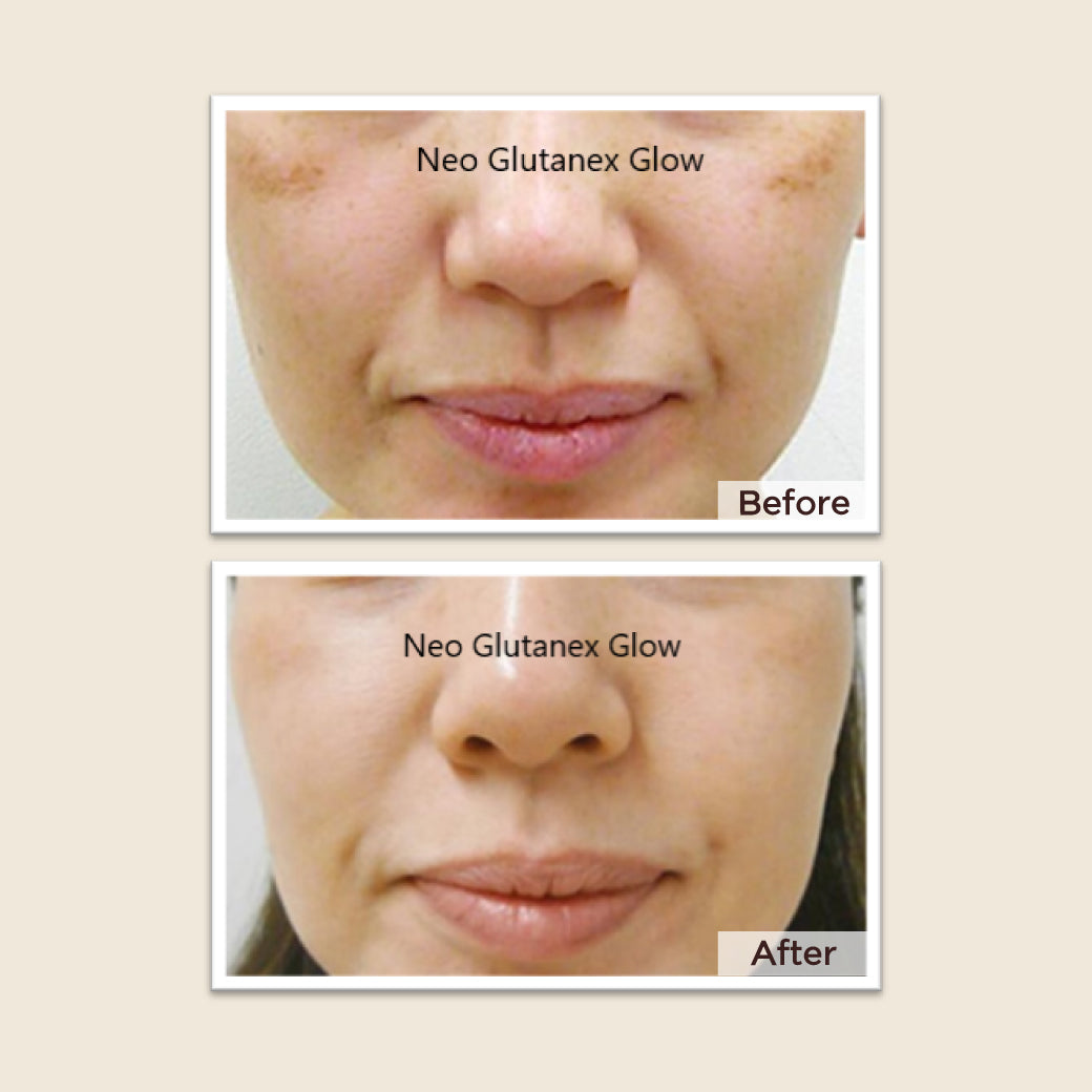 Meso Neo Glutanex Glow Facial Injection with Pure Glutathione, New from Korea