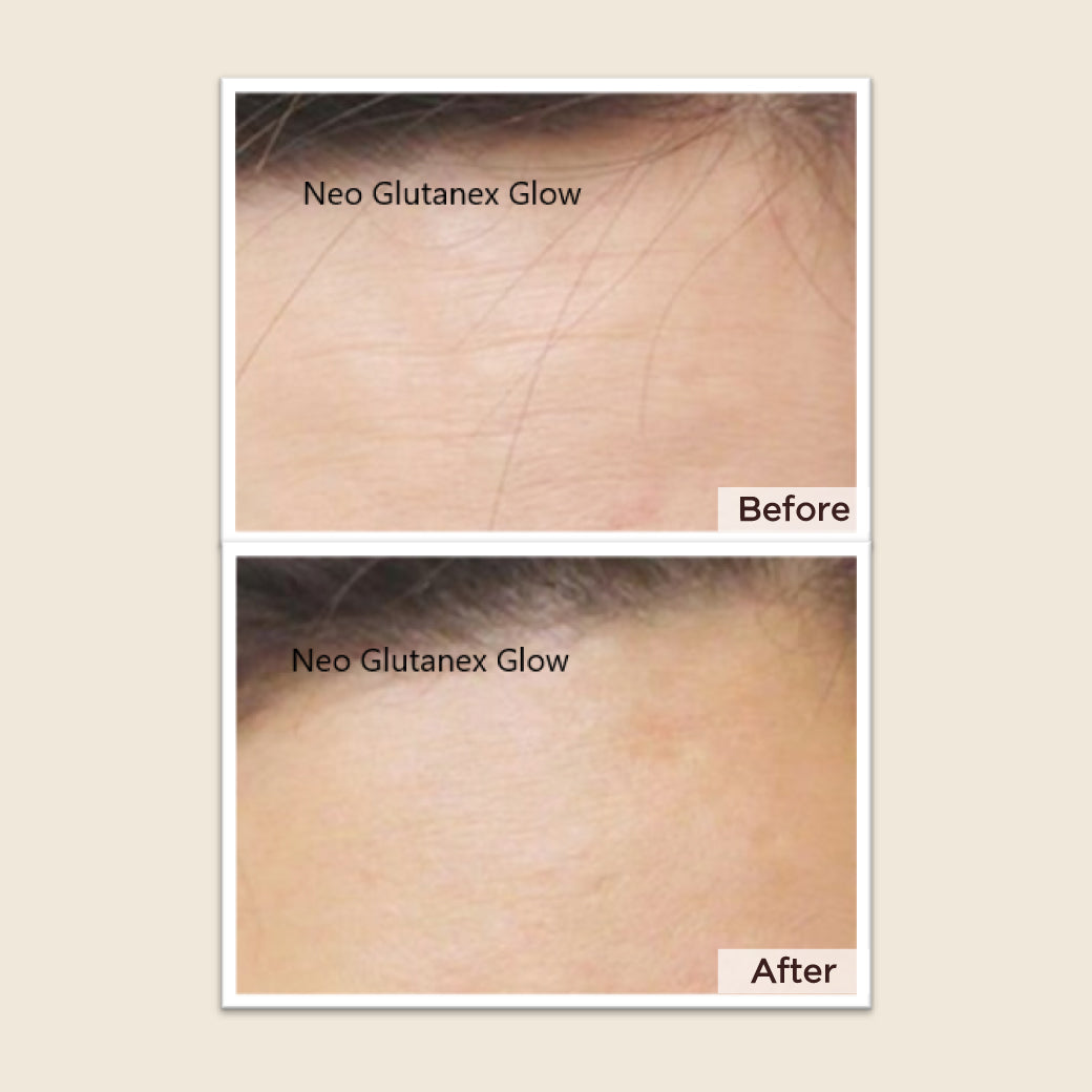 Meso Neo Glutanex Glow Facial Injection with Pure Glutathione, New from Korea