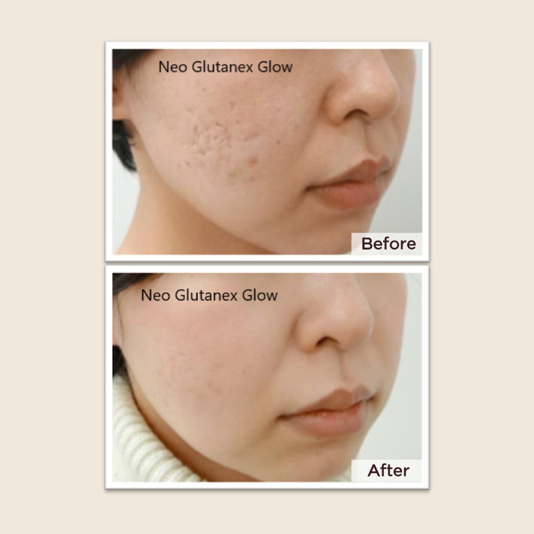 Meso Neo Glutanex Glow Facial Injection with Pure Glutathione, New from Korea