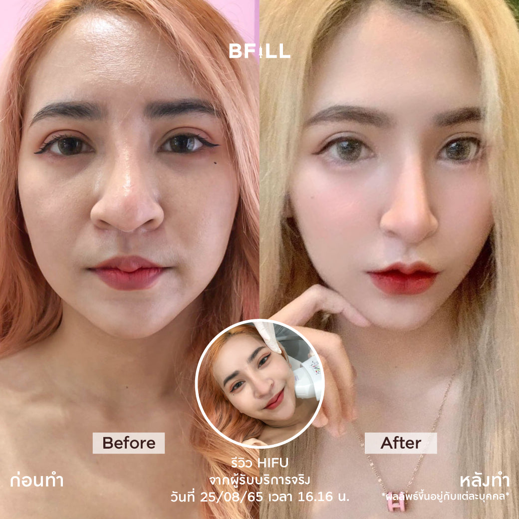 Hifu MPT Program By Specialist (Performed by Experts) Exclusive to Asok branch