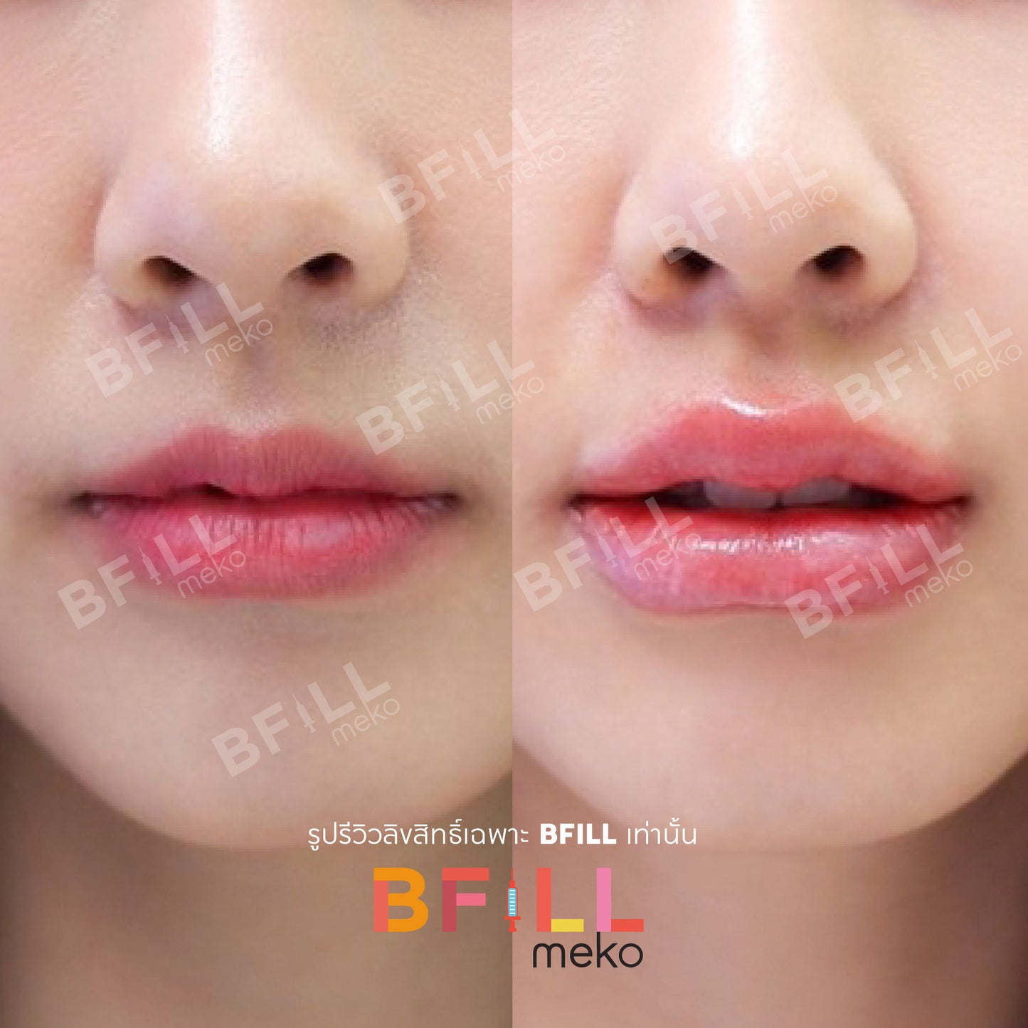 FILLER Korea or Restylane or Juvederm