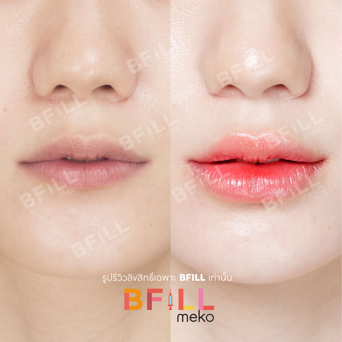 FILLER Korea or Restylane or Juvederm
