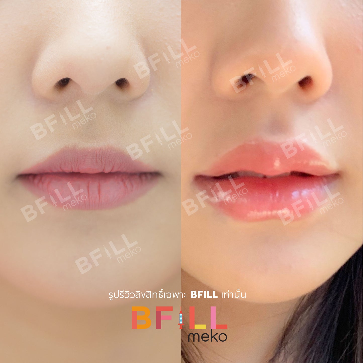 FILLER Korea or Restylane or Juvederm