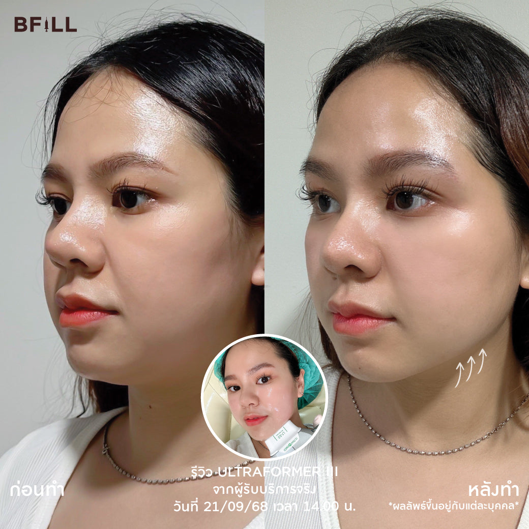 UltraFormer III 400 Shots Installment 12 months 1,250.-/month By Doctor