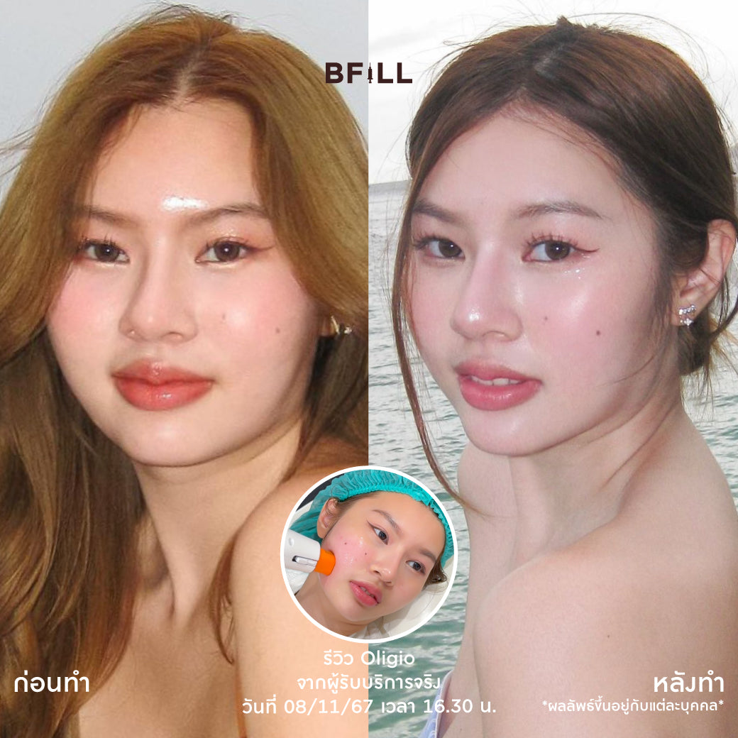 Program Oligio by Doctor Free Therma Lift by Specialist Only at Asok Branch Only Asok