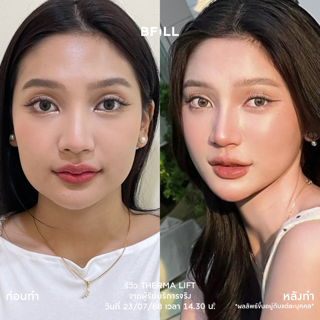 Program Therma Lift By Specialist เทอมาลิฟท์ ทำโดยผู้เชี่ยวชาญ