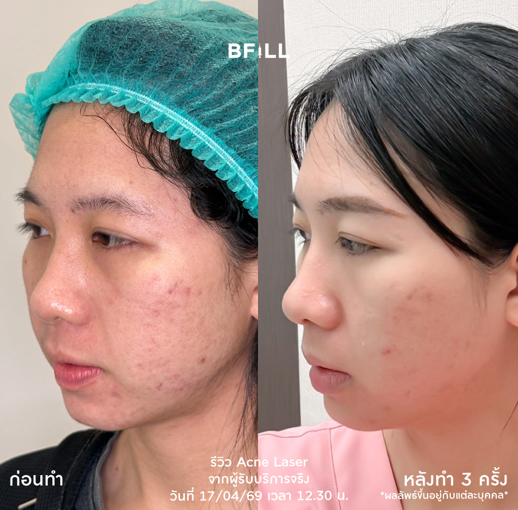 Program เลเซอร์กำจัดสิว Laser Only Asok