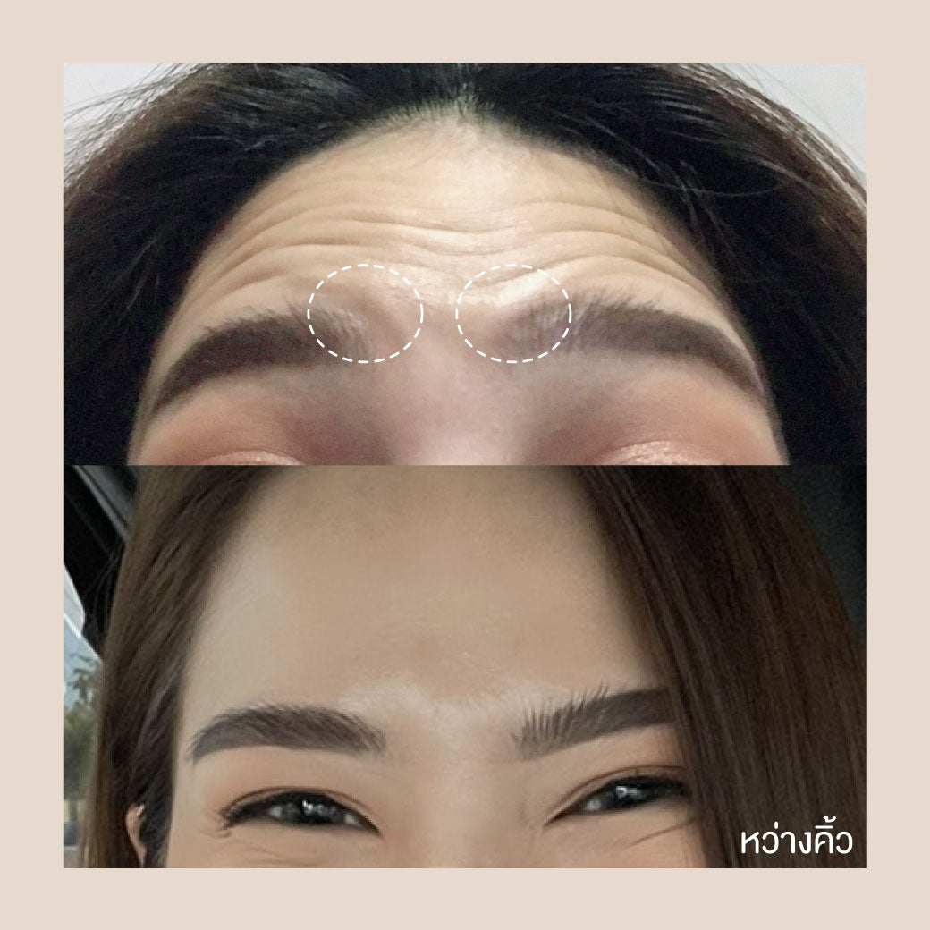 Botox Nabota 博图克 Nabota